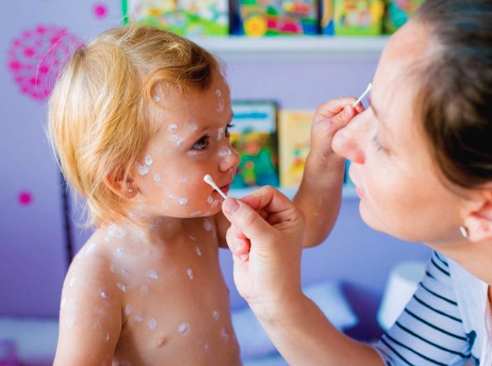 37. No More Discomfort From Chickenpox