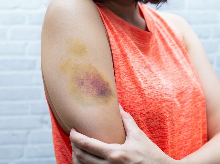 12. Help Heal Bruises