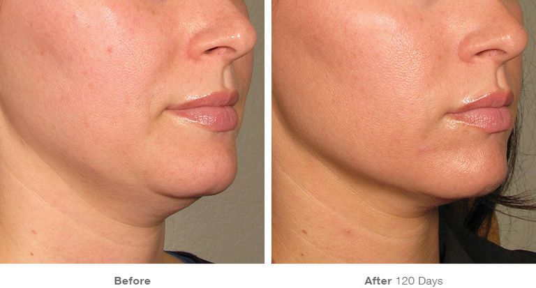 Skin Tightening