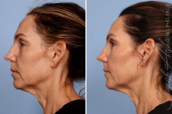 Facelift Without The Surgery