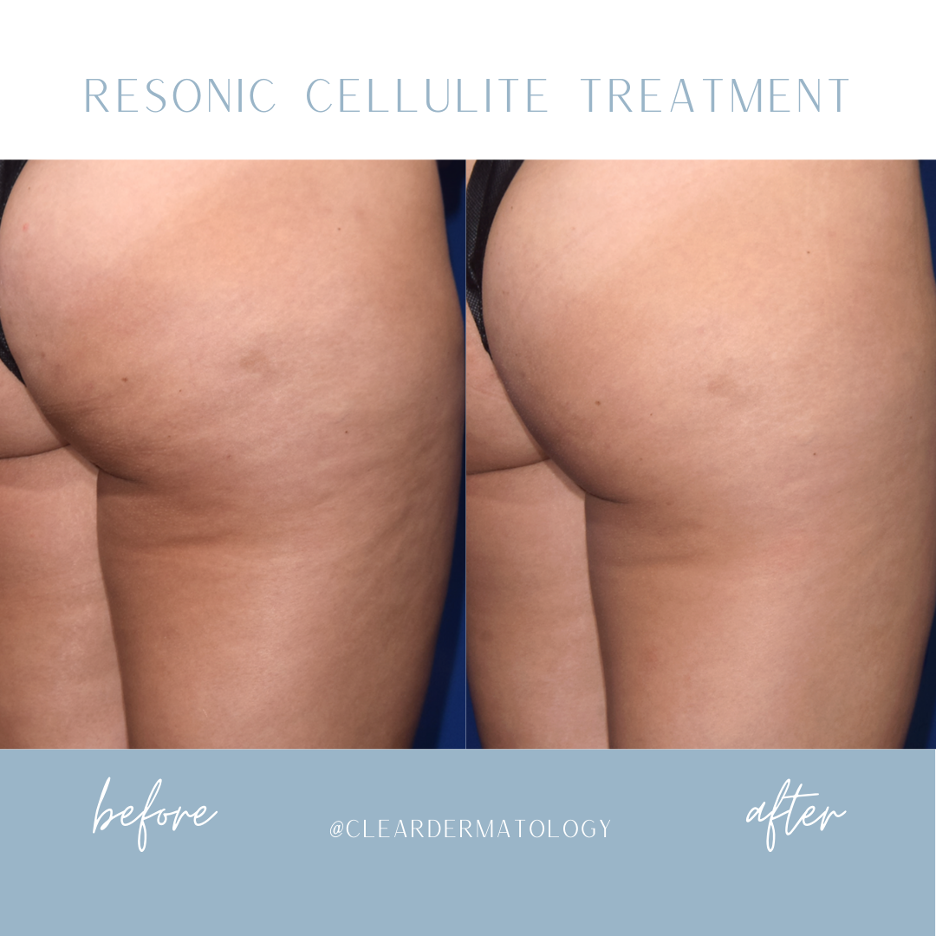 Cellulite Treatment